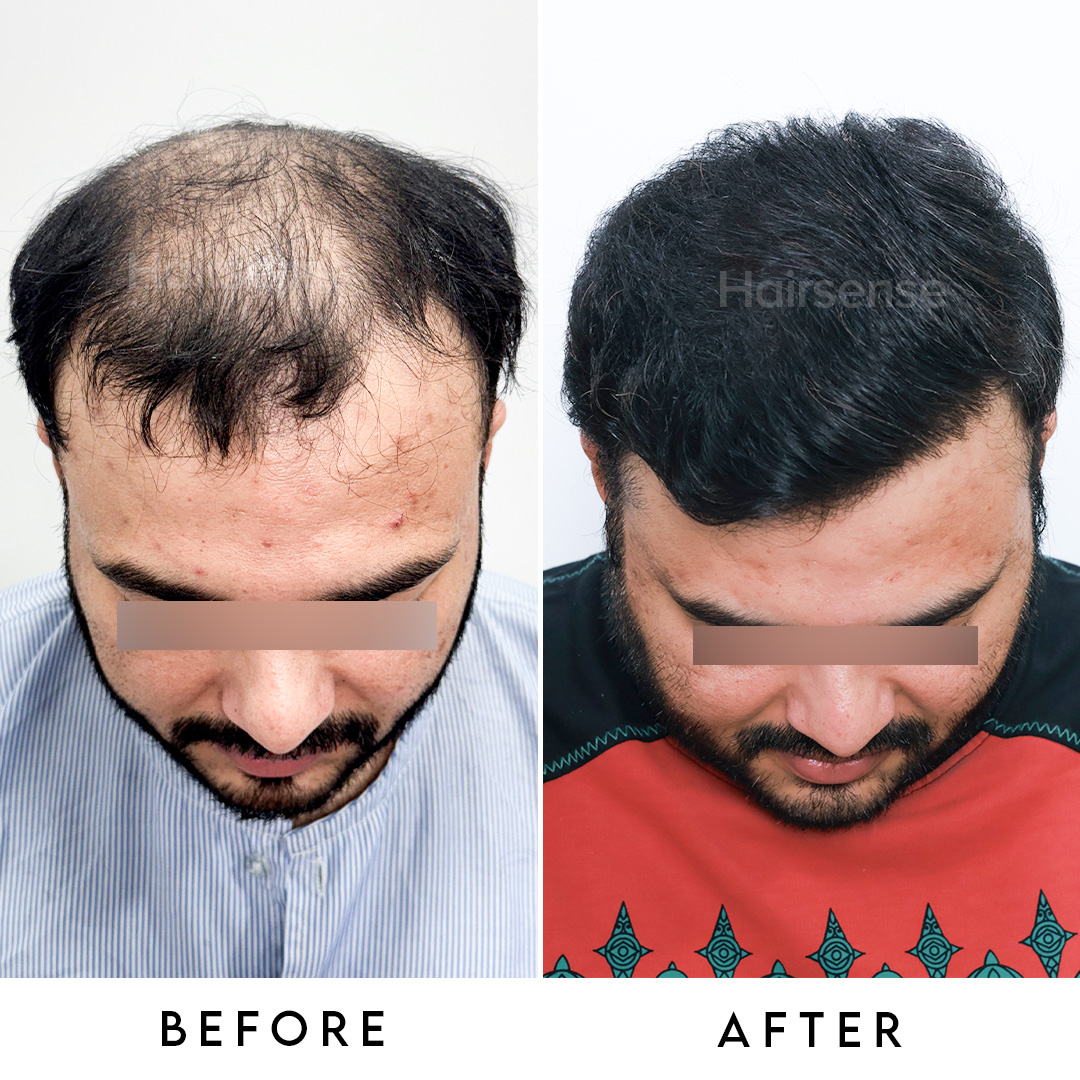 Hair transplant result 2