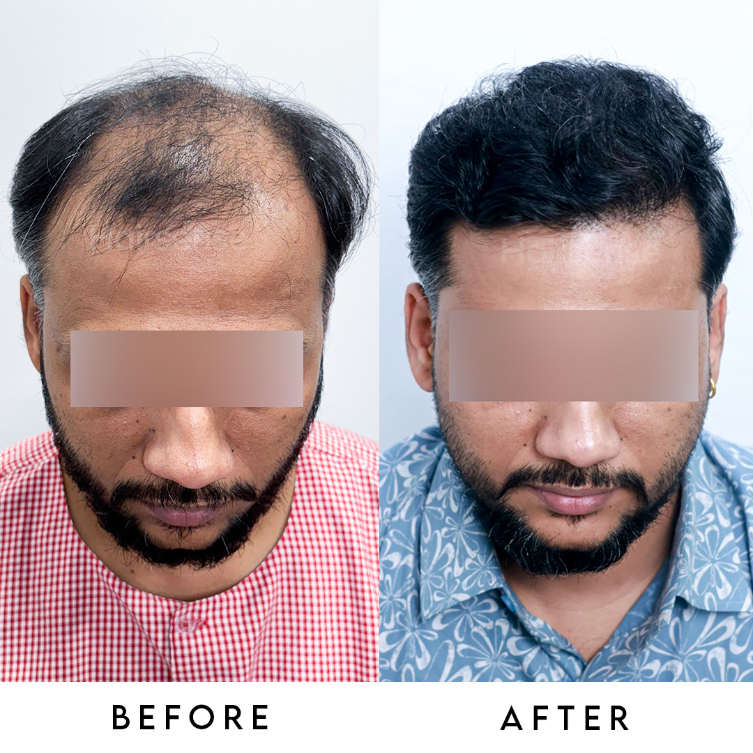 Hair transplant result 3